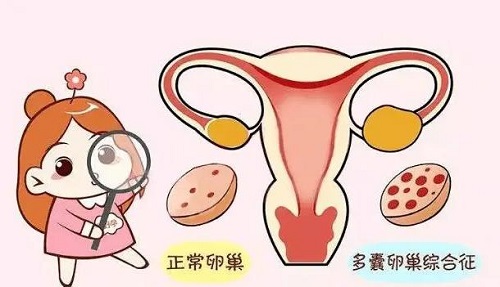 多囊卵巢会不会遗传？多囊卵巢综合症是否具有遗传性？